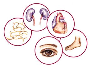Órganos a los que las complicaciones de la diabetes mellitus